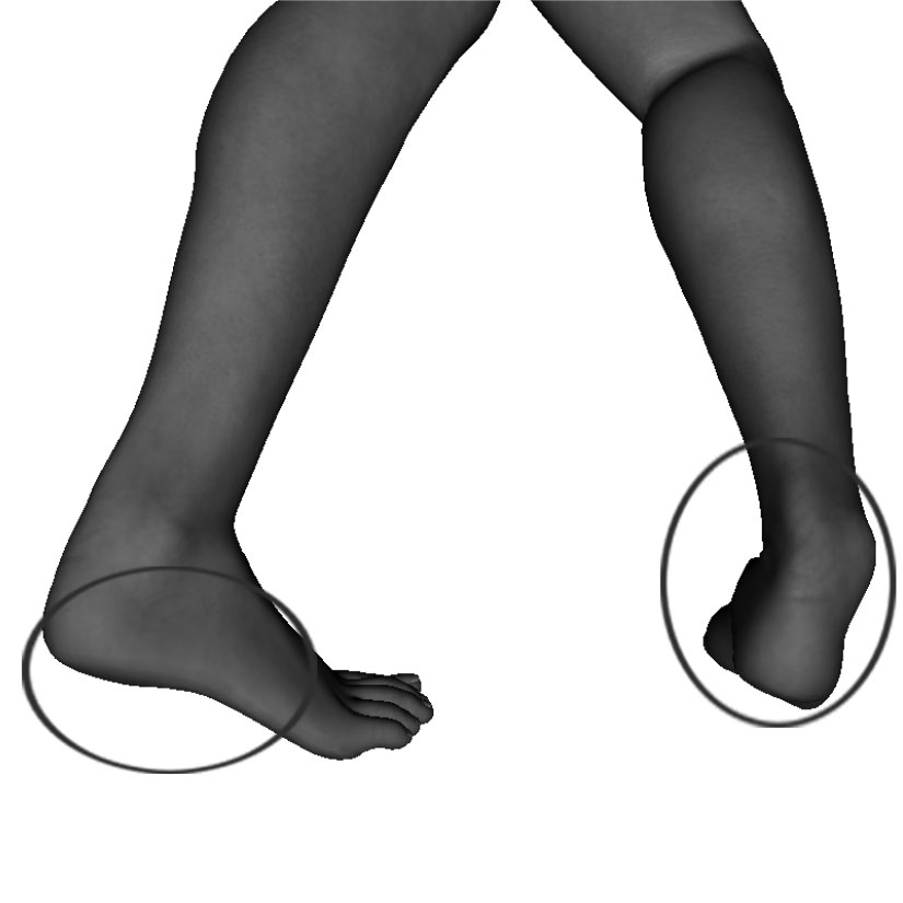 Example of improper buckle alignment foot not flat, ankle bent to side